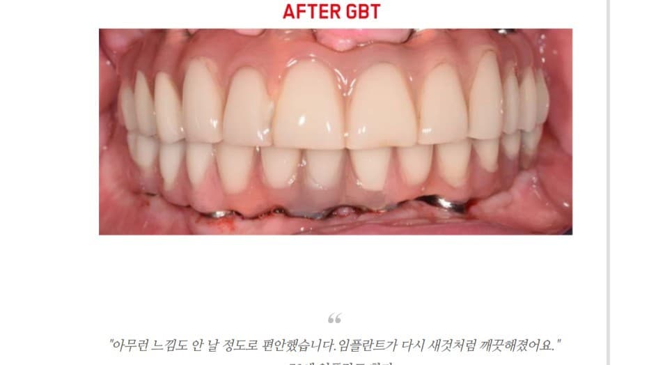소중한 임플란트, 쇠로 긁으시겠습니까? 임플란트 수명을 늘리는 프리미엄 관리