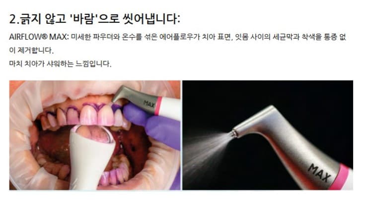 스케일링이 아프다고요? 베일러연합치과에서 '치아 스파' 받으세요! (EMS 에어플로우 도입)